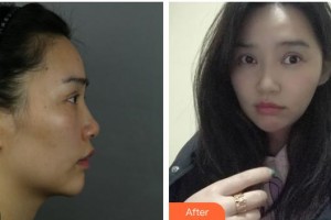 上海宏康醫(yī)院整形美容中心姜元植主診醫(yī)師整形價格表附	顴骨+頰脂墊+下頜角+皮質骨案例展示