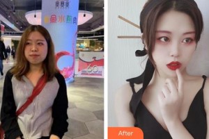 上海解放軍第四五五醫(yī)院激光整形科唐玲整形價格表附射頻溶脂瘦臉案例展示