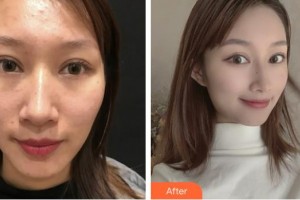 上海康奧醫(yī)療美容醫(yī)院趙華整形價格表附微針祛痘案例展示