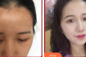 上?？祳W醫(yī)療美容醫(yī)院白俊杰整形價格表附發(fā)際線種植案例展示