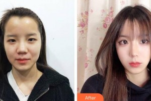 上?？祳W醫(yī)療美容醫(yī)院錢麟整形價格表附美鼻部手術案例展示