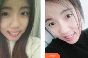 沈陽杏林整形美容醫(yī)院朱石江整形價(jià)格表附牙齒矯正案例展示