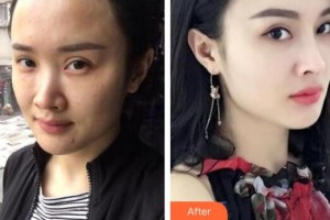 鄂爾多斯百達(dá)麗整形美容醫(yī)院李英春整形價(jià)格表附熱瑪吉頸部體驗(yàn)案例展示