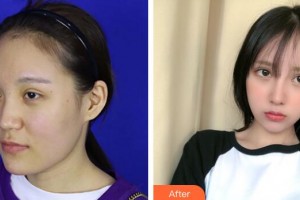 珠海華澳醫(yī)療美容整形門診部鄧強(qiáng)整形價(jià)格表附鼻部手術(shù)案例展示