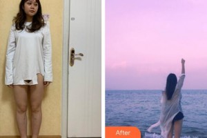 黑龍江省人民醫(yī)院整形美容中心范希明 教授整形價(jià)格表附吸脂瘦大腿案例展示