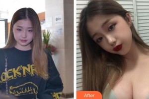 中山百佳婦產(chǎn)醫(yī)院醫(yī)療美容科李韻芳整形價(jià)格表附假體隆胸案例展示