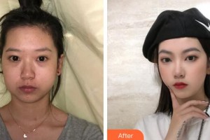 廣州華美醫(yī)療美容醫(yī)院李春滿整形價(jià)格表附下頜角磨骨案例展示