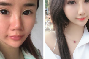 南京友誼整形外科醫(yī)院黃旭培整形價格表附肋軟骨隆鼻案例展示