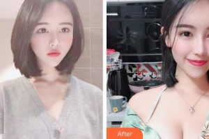 廣州軍美整形醫(yī)院肖強(qiáng)整形價(jià)格表附高端定制假體美胸案例展示