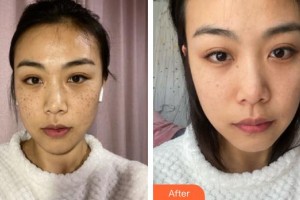 上海宏康醫(yī)院整形美容中心李愛濤整形價格表附祛斑日記案例展示