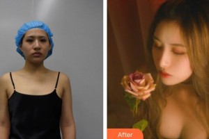 廣州美萊醫(yī)療美容醫(yī)院劉永波整形價(jià)格表附脂肪填充胸部案例展示