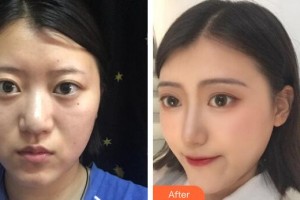 廣州名韓醫(yī)療美容醫(yī)院孫曉捷整形價(jià)格表附肋軟骨鼻部手術(shù)案例展示