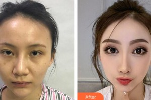 廣州軍區(qū)總醫(yī)院全軍激光整形美容中心彭麗霞整形價(jià)格表附鼻部手術(shù)整形案例展示