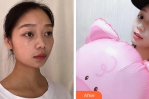 沈陽(yáng)杏林整形美容醫(yī)院劉建波整形價(jià)格表附水氧活膚案例展示