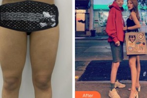 廣州美恩整形美容醫(yī)院徐元整形價(jià)格表附大腿吸脂案例展示