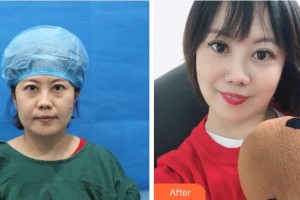 三門峽常亮醫(yī)療美容診所常亮整形價(jià)格表附不開刀祛眼袋+自體脂肪填充淚案例展示