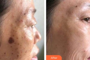 南寧華美整形美容醫(yī)院陳琳整形價(jià)格表附激光美膚祛斑案例展示