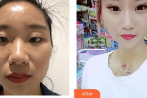 武警上?？傟?duì)醫(yī)院整形美容中心曹慧整形價(jià)格表附激光祛斑美白肌膚案例展示