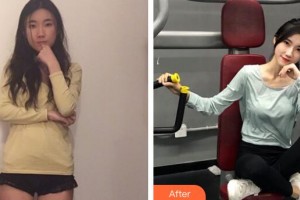 廣州愛來（原阿瑪施）醫(yī)療美容整形醫(yī)院余花整形價(jià)格表附玻尿酸導(dǎo)入案例展示