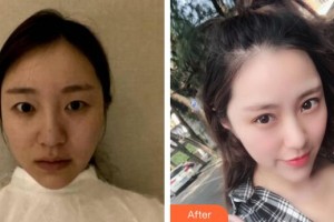廣州美恩整形美容醫(yī)院高卿豪整形價(jià)格表附眼部綜合案例展示