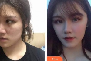 廣州時(shí)光整形美容醫(yī)院穆鈺整形價(jià)格表附人魚膠提升術(shù)案例展示