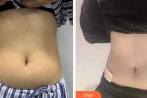 廣州廣美整形美容醫(yī)院李文鋒整形價(jià)格表附腰腹吸脂案例展示