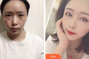 廣州軍區(qū)總醫(yī)院全軍激光整形美容中心孫瑞霞整形價(jià)格表附新月桃花眼部手術(shù)案例展示