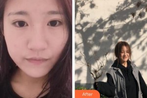 廣州凱美達(dá)整形美容醫(yī)院王之光整形價(jià)格表附無(wú)針?biāo)獍咐故?>
</a>
<h3 class=