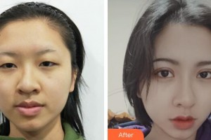 廣州軍區(qū)總醫(yī)院全軍激光整形美容中心熊杰整形價(jià)格表附眼部整形案例展示