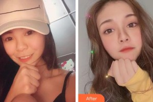 上海紐賽醫(yī)療美容門診部聶嬋整形價(jià)格表附玻尿酸導(dǎo)入案例展示