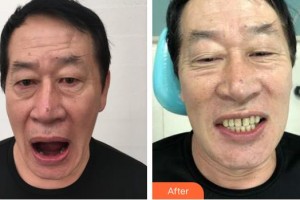 上海伊美爾港華醫(yī)療美容醫(yī)院李功勛整形價(jià)格表附種植牙案例展示