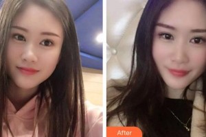 上海富華醫(yī)療美容醫(yī)院余平整形價(jià)格表附冷光美白案例展示