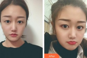 南方醫(yī)科大學(xué)附屬?gòu)V州燕嶺醫(yī)院整形美容中心雷濤整形價(jià)格表附埋線雙眼皮案例展示