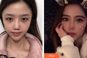 廣州軍區(qū)總醫(yī)院全軍激光整形美容中心譚拯整形價(jià)格表附眼部綜合案例展示