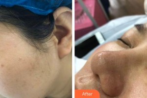 上海瑞麗整形美容醫(yī)院白容官整形價格表附果酸祛角質、黑頭、粉刺雞、皮膚案例展示