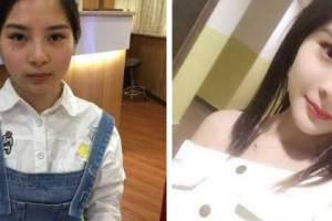 南京市六合區(qū)人民醫(yī)院燒傷整形科方箭整形價(jià)格表附顴骨內(nèi)推案例展示