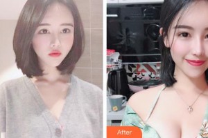 上海美侖醫(yī)療美容門診部于彬整形價格表附高端假體復合隆胸案例展示