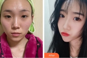 上海韓春民整形外科診所韓春民整形價格表附顴骨內推案例展示