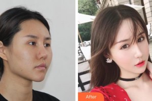 上海博愛醫(yī)院整形科彭少成整形價(jià)格表附頜面整形案例展示