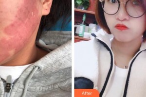 上海新星醫(yī)療美容整形外科楊紅華整形價格表附點陣祛痘坑痘印案例展示