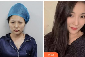 上海新極點醫(yī)療美容診所戴紅整形價格表附黃金微雕全臉案例展示