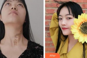 上海交通大學(xué)附屬瑞金醫(yī)院燒傷整形科董鶴亮整形價(jià)格表附燙傷疤痕修復(fù)案例展示