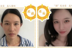 上海市第一人民醫(yī)院整形外科沈尊理整形價(jià)格表附埋線雙眼皮案例展示