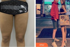 上海復(fù)旦大學(xué)附屬華山醫(yī)院整形外科周兆平整形價(jià)格表附大腿吸脂案例展示