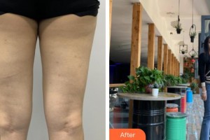 上海第二軍醫(yī)大學(xué)附屬長(zhǎng)征醫(yī)院整形外科朱曉海整形價(jià)格表附大腿吸脂案例展示