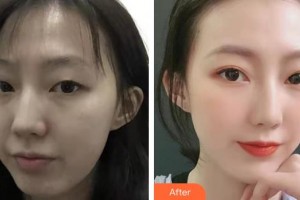 上海第二軍醫(yī)大學(xué)附屬長(zhǎng)征醫(yī)院整形外科袁湘斌整形價(jià)格表附創(chuàng)可貼面部吸脂瘦臉?biāo)茌喞咐故?>
</a>
<h3 class=