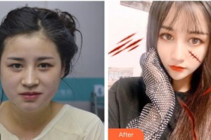 煙臺(tái)華怡醫(yī)學(xué)美容醫(yī)院張上海整形價(jià)格表附面部光纖案例展示