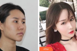 上海伊美爾港華醫(yī)療美容醫(yī)院巴希尓·阿特馬尼整形價(jià)格表附頜面整形案例展示