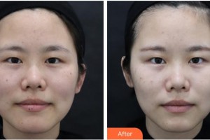 上海德琳醫(yī)療美容醫(yī)院李鎬均整形價(jià)格表附激光祛斑案例展示