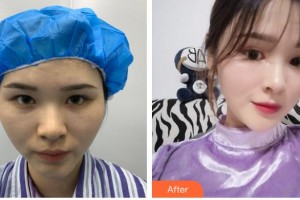 上海伯思立醫(yī)療美容門診部沈國雄整形價(jià)格表附面部吸脂案例展示